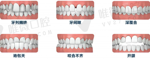 什么情况下窝沟封闭不用做,牙齿窝沟封闭是什么情况(图1)